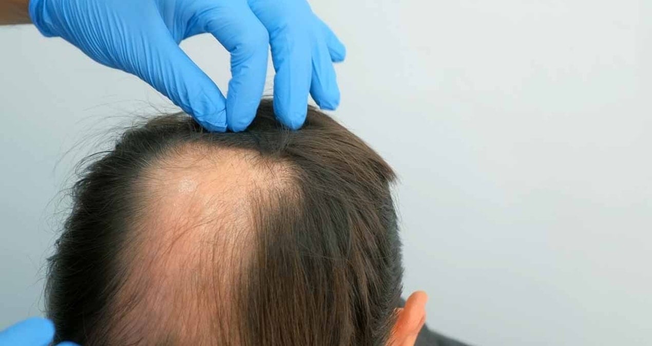 Stresin neden kelliğe yol açtığı belli oldu