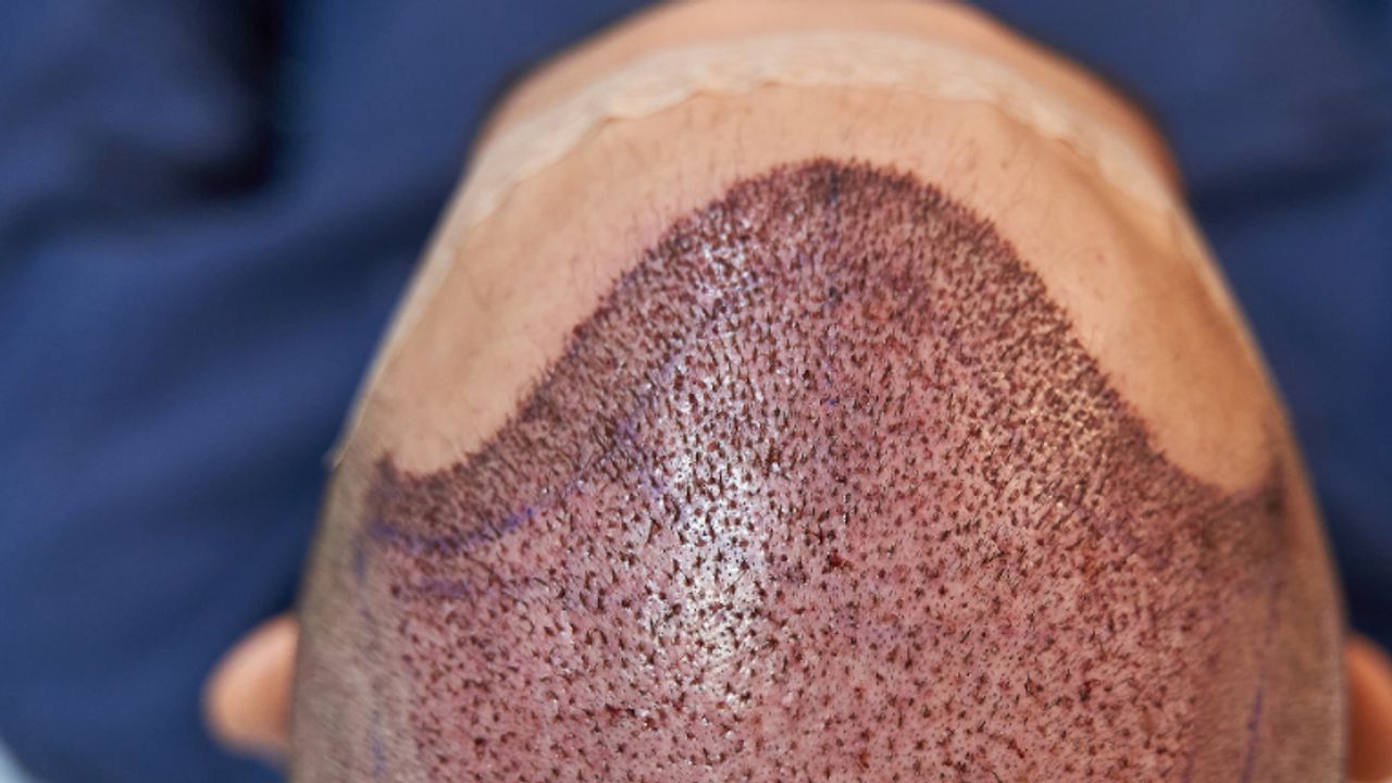 Saç Ekimi Yardımcı Uygulayıcılar İçin Ulusal Standart Yürürlüğe Girdi